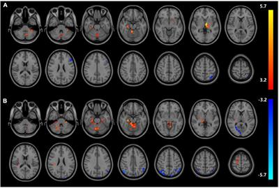 Abnormal regional homogeneity and amplitude of low frequency fluctuation in chronic kidney patients with and without dialysis